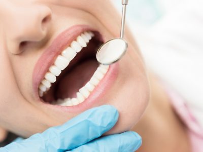 Composite Fillings