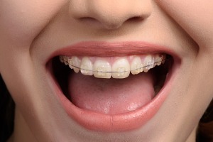 Woman smiling with Adult Braces in Normal IL