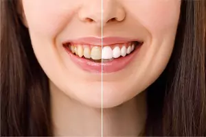 Teeth Whitening Near Me