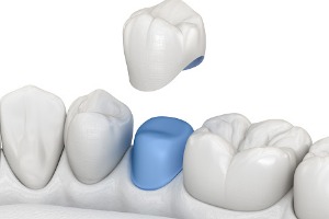 Porcelain dental crowns are placed over a tooth to repair damage